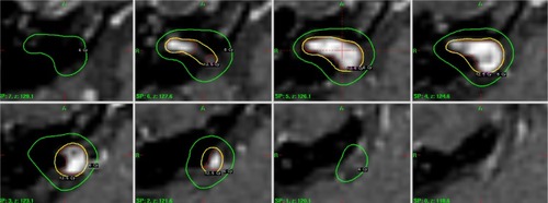 Figure 2 Axial dose distribution on a VS target volume superimposed onto the T1 post-contrast serial MR scans with a slice thickness of 1.5 mm.Abbreviation: VS, vestibular schwannoma.