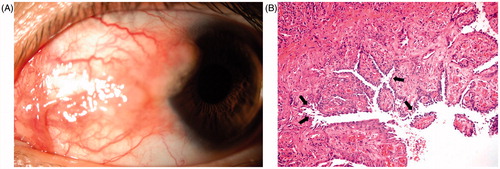 FIGURE 1. (A) Clinical picture shows solitary, lobulated conjunctival tumoral mass associated with conjunctival hyperemia encroaches on the cornea nasally. (B) Histopatology demonstrates suprabasal acantholitic separation (arrows) in the conjunctival epithelial cells and subepithelial congested vessels giving a papillary configuration to mucosa (hematoxylin–eosin stain × 200).
