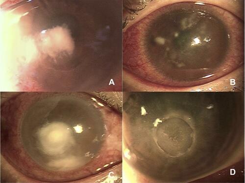 Figure 1 Cases of suspected infectious keratitis who were treated with topical corticosteroids without culture-proven diagnosis and before presentation to our clinic. (A) Case 11; Forty-four-year-old female. Although fungal keratitis was suspected based on corneal findings, it took only 3 weeks to cure the inflammation by a combination of topical antibiotics and anti-fungal therapy. (B) Case 12; Eighteen-year-old female. Early stage of Acanthamoeba keratitis was suspected based on the findings, but no organism could be cultured, even after co-culture with Escherichia coli. (C) Case 13; Fifty-one-year-old male. Despite treatment with a combination topical antibiotic and antifungal therapy, corneal perforation occurred 2 weeks after the first visit. (D) Case 14; Thirty-five-year-old male. Culture was attempted 3 times from the first visit, and at the second time of culture, 1 week after the intensive topical antibiotic therapy was started, methicillin-resistant Staphylococcus epidermis was detected by enrichment culture, but the significance of this result was unclear.