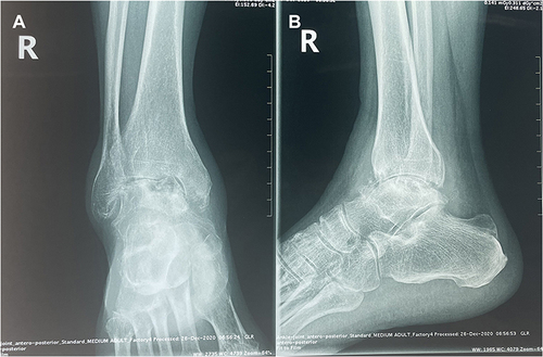 Figure 1 X-Ray examination of the patient on admission. (A and B) Coronal and sagittal radiographs demonstrated collapsed articular surfaces and narrowed joint spaces in the talus bone.