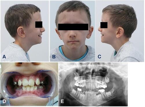 Figure 1 Facial phenotype (A–C), occlusion (D) and panoramic radiograph (E).