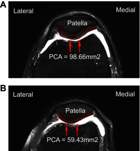Figure 1 Measurement of the patellar cartilage cross-sectional area (PCA) on transverse turbo spin echo fat-suppressed T2-weighted image. (A) Control group. (B) Knee tibiofemoral osteoarthritis group.