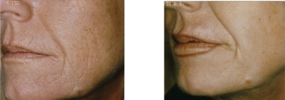 Figure 4 Combination approach: skincare, HA lip enhancement 12 months post-Erbium-Yag laser skin resurfacing.