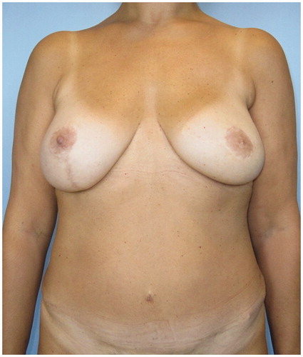 Figure 1. Frontal view. Patient with a previous left supero-lateral quadrantectomy and lymphadenectomy underwent left skin sparing mastectomy (SSM) and immediate DIEP flap reconstruction and contralateral mastopexy.