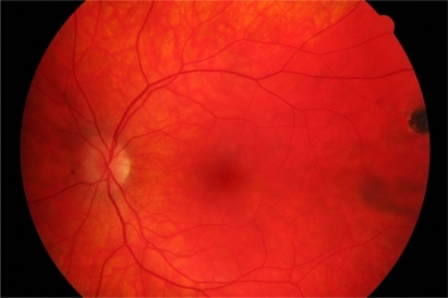 Figure 2 Inactive chorioretinal scar in temporal periphery of left eye.
