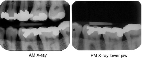 Figure 2. X-ray image comparison. The bright white areas in the tooth crowns represent the unique shapes of metal amalgam fillings. The chances of getting such a level of similarity between the teeth, filling shapes and bone levels in two individuals chosen at random would be exceedingly small, so it is reasonable to state that these images originate from the same person. (Image courtesy Health Support Queensland Forensic and Scientific Services (HSQ FSS) and the Queensland State Coroner, with permission).