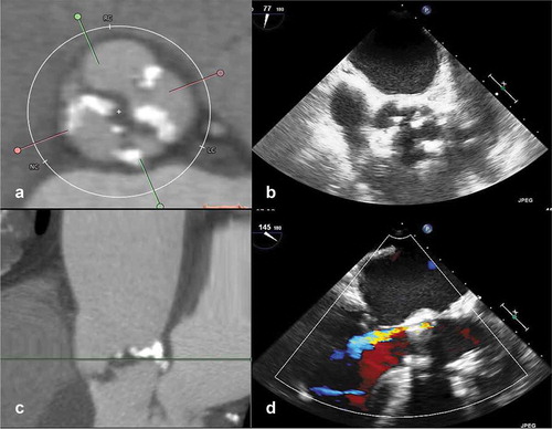 Figure 2. Association between aortic valve calcification and paravalvular regurgitation after transcatheter aortic valve implantation