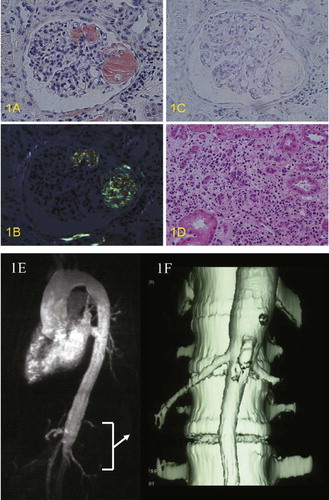 Figure 1. Renal biopsy specimens: (A) Congo-Red staining, (B) Congo-Red staining with polarization filter, (C) Congo-red staining after KMnO4 treatment, (D) HE staining, and (E,F) magnetic resonance angiography. (A,B) Congo-red positive lesions were seen in glomeruli and vascular walls. (C) These lesions were KMnO4 non-resistant (AA type). (D) Severe interstitial nephritis was also noted. Magnetic resonance angiography (1E) revealed the narrowing of the lower abdominal aorta distal to the renal artery. Renal arteries were not involved in her Takayasu's arteritis. 3D-CT (1F) confirmed the stenosis of the abdominal aorta but not the renal arteries.