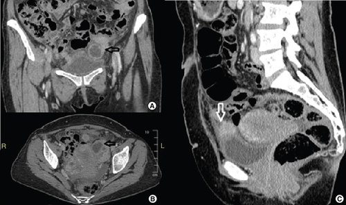 Figure 1. Pelvic computed tomography scan images during first emergency admission.(A & B) Contrast enhanced computed tomography showing the conglomerated mass around the left adnexa filling the pelvis on coronal and axial views. (C) Enhanced 2 cm implant lying on the bladder dome and infiltrating its wall with a bulging effect.