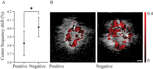 Figure 4. (A) Graph showing the centre frequency shifts (CFS) for temporal artery biopsy TAB-positive and TAB-negative biopsies. Data are presented as mean values with 95% confidence intervals. *Significant difference between the two groups (p < 0.05). (B) Representative examples of CFS images of a TAB-positive (left) and a TAB-negative (right) specimen of the temporal artery. The value of CFS (%) for each pixel is shown as a darker (red) overlay. The scale bar is 0.1 mm.
