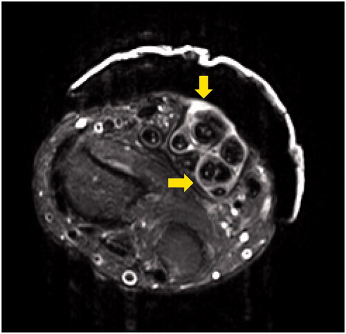 Figure 2. Contrast-enhanced MRI showing hypertrophy of the synovial sheath on the flexor tendon (arrows) with T2 fat suppression.