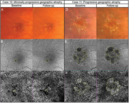 Figure 6. Two presentations of geographic atrophy with different rates of progression over a one-year-period. (Case 10) Slow progressing atrophy in a 71-year-old female with visual acuity of 6/15. (A) Medium and large drusen with focal geographic atrophy inferotemporal to the fovea in the right eye with colour fundus photography at baseline and follow-up visits. (B) Slight enlargement of hypo-autofluorescent area corresponding to an area of atrophy. (C) The areas where there is a subtle increase in flow signal demonstrates modest enlargement on 6 × 6 mm OCT-A image set at the choriocapillaris across visits (dashed lines). (Case 11) Fast progressing atrophy in an 83-year-old female with visual acuity of 6/19. (D) Medium and large drusen with pigmentary abnormalities and multiple areas of geographic atrophy demonstrating notable enlargement at follow-up. (E) Coalescence of hypo-autofluorescent regions between baseline and follow up. (F) 6 × 6 mm OCT-A image set at the choriocapillaris shows a greater extent of increased flow signal at baseline (dashed lines).