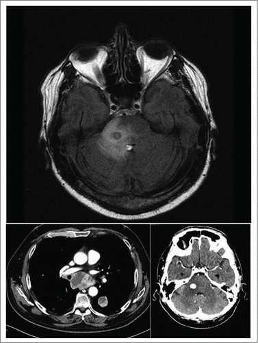 Figure 4. After 5 cycles of chemotherapy, a total body CT demonstrated systemic progressive disease. In the figure lymph node, pulmonary and brain progression is depicted. The brain MR confirmed brain progression, with the enlargement of the known pontis lesion and the onset of a new frontal node of about 1 cm (not shown) surrounded by diffuse edema.