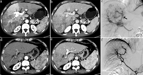 Figure 2 Representative radiographical images of a patient who achieved APS disappearance after treatment. Images of man aged 50 years with HCC and severe APS after receiving the combination therapy. Axial contrast-enhanced CT images in the arterial phase (a) and portal phase (b) before the initiation of treatment. CT images taken during the arterial phase (a) displayed early enhancement of portal vein branches (indicated by a black arrow), representing APS. Hepatic angiography (c) revealed severe APS (indicated by a black arrow). Subsequent axial contrast-enhanced CT images in the arterial (d) and portal (e) phase were taken after three sessions of HAIC, showing no apparent APS. Hepatic angiography in image (f) confirmed the absence of APS.