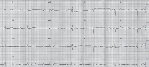 Figure 1. Complete atrio-ventricular block and sinus tachycardia with narrow QRS at admission ECG.