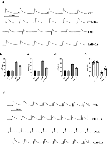 Figure 4. Effects of Dapagliflozin administration on the electrophysiological properties in PAH’s rats. Representative images of S1S1 stimulation (a). Analysis of APD20 (b), APD50 (c), and APD90 (d). Representative examples of ERP and analysis of ERP (e-f) (n = 8–10 per group). Data are presented as mean as ±SEM. *P < 0.05 vs. CTL group, #P < 0.05 vs. PAH group. **P < 0.01 vs. CTL group, ##P < 0.01 vs. PAH group. Abbreviations: APD20, action potential duration 20; APD50, action potential duration 50; APD90, action potential duration 90; ERP, effective refractory period.