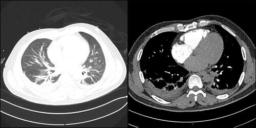 Figure 2 Pulmonary computed tomographic angiography (CTA) showed bilateral pleural effusion and inflammation (pulmonary window and mediastinal window).