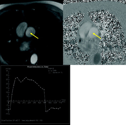 Figure 9 Quantitative flow measurement of pulmonary blood flow. Magnitude (A) and velocity encoded (B) image of pulmonary trunk (arrow). Results of peak velocity over time (C) show the normal increase of velocity at the beginning of systolic phase following by abnormal plateau and regurgitation during diastole.