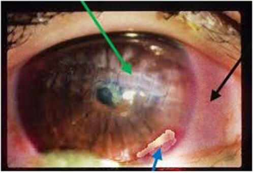 Figure 1 Klebsiella oxytoca induced keratitis showing hypopyon, redness, ulcer and stitch on cornea sclera after admission. Green arrow shows ulcer, black arrow shows redness of eye, and blue arrow shows hypopyon.