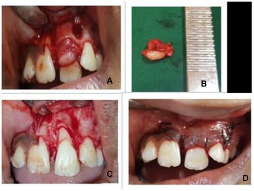 Figure 4 (A) Internal bevel incision given and flap raised. Gingival enlargement is seen attached to underlying tissue. (B) Lesion excised (C) after curettage of surgical site. Bone loss is seen in the buccal aspect of 21. (D) After suturing.