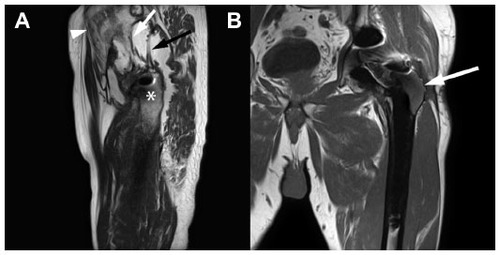 Figure 8 Sagittal T2 weighted (A) and coronal T1 weighted (B) magnetic resonance images through two different left metal-on-metal total hip replacements. A large periprosthetic fluid collection (A) is associated with dehiscence of the pseudocapsule and avulsion of the gluteus medius (black arrow) and minimus (white arrow) tendons from the greater trochanter (asterisk) with fatty atrophy of the gluteus medius and minimus muscles (arrowhead). In (B), there is replacement of normal marrow signal on T1W in the greater trochanter (arrow), representing adverse reaction to metal debris with no soft tissue changes. This would not have been detected by ultrasound.