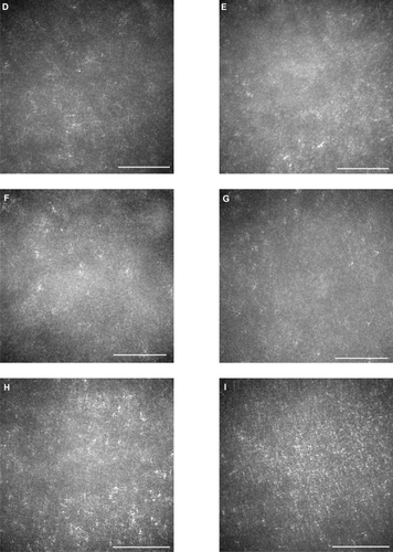 Figure 3 Adaptive optics (AO) images of the fovea of a normal eye (A), and right/left eyes of patient 1 (B, C), patient 2 (D, E), patient 3 (F, G), and patient 4 (H, I). Bars represent 100 μm. In the eyes of the patients, signals from the cone mosaic were attenuated, and the bright spots were distorted (B–H). One eye which had normal visual acuity had an almost normal appearance in the foveal center, with some dark areas around the fovea.