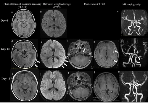 Figure 1. Imaging findings. (a – c): on the 6th day after symptom onset, MRA of the head revealed narrowing of the left middle cerebral artery (c, arrow). Diffusion-weighted images (DWI) and fluid-attenuated inversion recovery (FLAIR) show no lesions. (d,e): on the 15th day after symptom onset, DWI and FLAIR show cortical high-intensity areas in the left cerebral hemisphere (arrow). (f,g): contrast-enhanced effects can be observed in the vessel walls of the left middle cerebral arteries, some of which are nodule-like or concentric (arrow). (h): MRA shows stenosis in the left internal carotid artery and left middle cerebral artery (arrow), and peripheral delineation is slightly poor on the affected side. (i – m): on the 157th day, after symptom onset abnormal findings are noted to have improved.