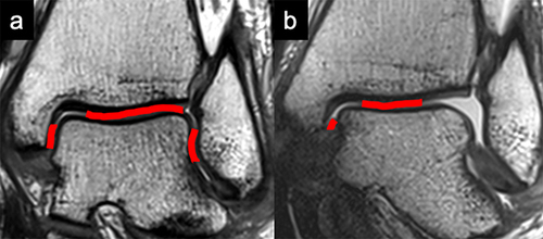 Figure 1 Ankle Instability. (a) Coronal reconstruction of a three-dimensional MRI (intermediate weighted turbo-spin-echo) sequence in neutral position. Red indicates the cartilage contact area. (b) Coronal reconstruction of a three-dimensional MRI (intermediate weighted turbo-spin-echo) sequence in plantarflexion-supination. Red indicates the cartilage contact area. As compared to neutral position, severely reduced cartilage contact area can be observed in plantarflexion-supination.