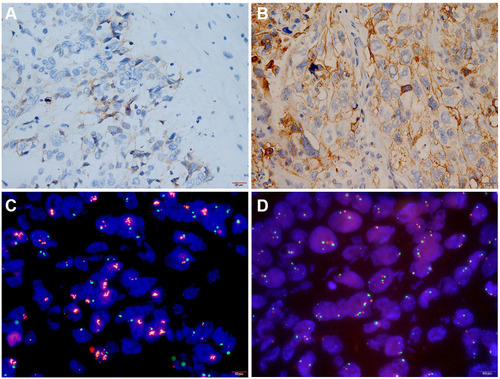 Figure 1 PD-L1 protein expression and gene amplification in lung squamous cell carcinoma. (A and B) Representative images of PD-L1 protein expression. (A) Low to moderate expression of PD-L1 (1%≤TPS≤49%) × 400. (B) High expression of PD-L1 protein (TPS> 50%) × 400. (C and D) Representative images of PD-L1 gene amplification analysed by FISH. (C) PD-L1 gene amplified Ratio > 2, parts of PD-L1 gene (red fluorescence) were expressed in clusters ×1000. (D) PD-L1 gene without amplification×1000.