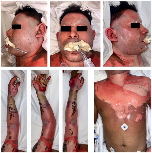 Figure 1. Appearance of the patient early after admission to the intensive care unit.