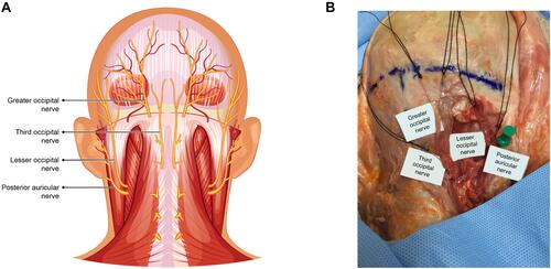 Figure 1 Nerve map of intended treatment area, including greater occipital nerve and lesser occipital nerve (A), and anatomical dissections of the treatment area (B).