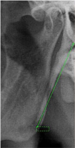 Figure 1 Measuring the length of the styloid process.