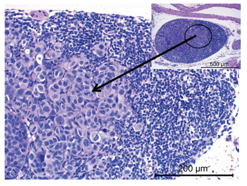 Figure S2 Histopathological evaluation indicating the presence of cancer cells in mediastinal lymph node of saline control.Notes: Arrow indicates the presence of cancer cells. Representative image of lymph node metastasis is presented.