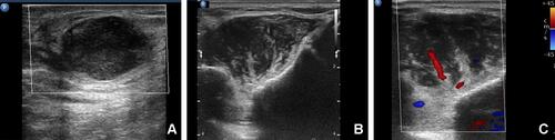 Figure 1 Ultrasound examination of the masses in the right breast and chest wall. (A) A heterogeneous hypoechoic mass with enhanced echo in the rear was found in the right breast. (B) A hypoechoic mass with striped hyperechoic feature was found in the chest wall. (C) Color Doppler Imaging of the mass in the chest wall displayed strip blood flow with high resistance index.