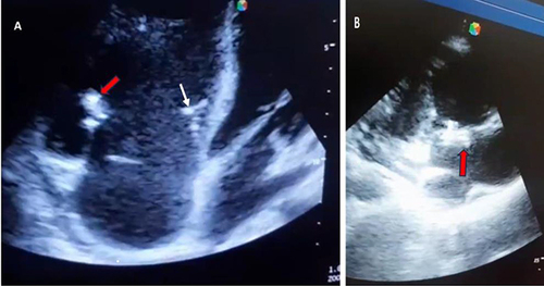 Figure 3 Transthoracic Echocardiography showing large vegetation on anterior leaflet of tricuspid valve (red arrows) and small Septal leaflet of tricuspid valve (white arrow) with Dilated Right Cardiac Chambers: Apical 4 chamber View (A) and RV inflow View (B).