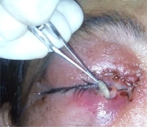 Figure 4 Mechanical removal of maggots with wound debridement.
