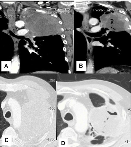 Figure 3 CT images from patient 2.