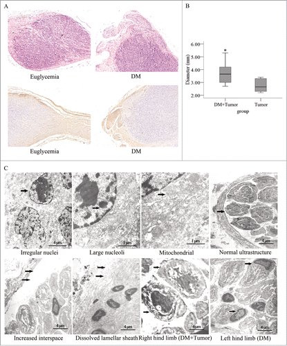 Figure 6. Histopathological photomicrographs of pancreatic tumors in diabetic and normal nude mice. (A) Hematoxylin and eosin staining and immunostaining for a primary anti-NF200 antibody of sections for nerves and PanCa cell tumor sections. The tumor tissue penetrated the nerve tissue in an invasive manner (original magnification, ×100). The tumor diameters were larger (B) in the diabetic mice than in the normal mice. (C) In the electron micrographs of sciatic nerve invaded by pancreatic tumors, PanCa cells exhibited irregular nuclei (arrow) as well as mass-like accumulations and large nucleoli (arrow). Their mitochondrial structure was normal (arrow). The interspace between the nerve fiber and lamellar sheath increased significantly (arrow). The lamellar sheath segmentally dissolved (arrow), and extensive SC apoptosis in sciatic nerve of DM was detected. The layered structure of the myelin sheath was loose and had dissolved in the right and left limbs of mice in the diabetic group. In addition, the neurites remained intact in the right hind limb (arrow) but dissolved in the left hind limb (arrow).