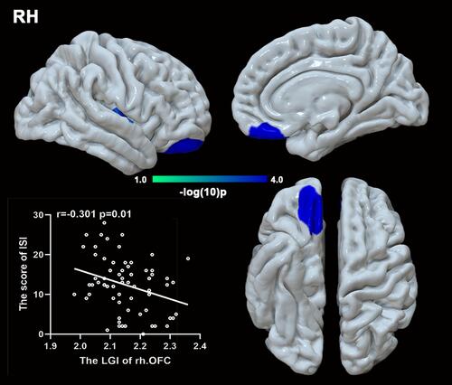 Figure 2 Local gyrification index (LGI) comparison in the right hemisphere. Patients with GAD displayed hypogyrification in the insula and orbitofrontal cortex (OFC). A negative relationship was found between the LGI of the OFC and insomnia.
