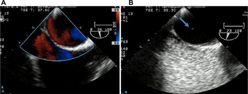 Figure 2 Echocardiogram TEE PFO.