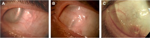 Figure 5 Color photographs of the temporal conjunctiva overlying the electronics case 4 years after Argus II retinal prosthesis implantation.