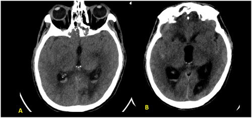Figure 5. (A, B) Unenhanced axial CT brain images revealed hyperdense material layering within the atria of the lateral ventricle and outlining the sylvain fissures bilaterally indicating intraventricular and subarachnoid hemorrhage with subsequent acute hydrocephalus and transependymal CSF permeation.