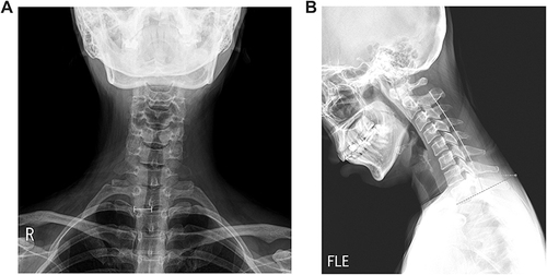 Figure 6 (A) AP image of cervical x-ray; MLD is measured from midline of cervical vertebra to lateral border of vertebral body. (B) Lateral image of cervical x-ray; dashed line represents line along the lower margin of T1 vertebra. Solid line is spinolaminar line. Dash-dotted line represents PMD. PMD is measured from skin where dashed line meets to spinolaminar line at middle of between C7 and T1 spinous process.