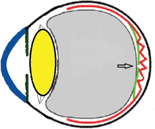 Figure 14 Schematic drawing showing the severe vitreous pressure from weightlifting putting tension on the thinnest portion of the epiretinal membrane with subsequent rupture of epiretinal membrane.