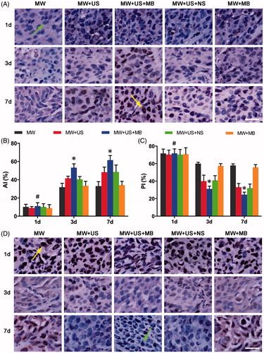 Figure 5. Immunohistochemical examination showing the enhanced cell death of residuals in the presence of MBs in combination with US after ablation. (A) TUNEL assay images of each T-Group in 1 d, 3 d and 7 d after ablation. Arrow (green) in the first line indicates a TUNEL negative cell, and arrow (yellow) in the third line indicates a TUNEL positive cell. (B) AI of each T-Group at different days after ablation (*p < .05, vs. the other T-Groups on the same day. #p > .05 vs. the other T-Groups in the same day. (C) PI of each T-Group at different days after ablation (*p < .05 vs. the other T-Groups on the same day. #p > .05 vs. the other T-Groups on the same day. (D) PCNA assay images of each T-Group 1 d, 3 d and 7 d after ablation. Arrow (yellow) in the first line indicates a PCNA positive cell, and arrow (green) in the third line indicates a PCNA negative cell. Magnification, 400×; scale bar, 25 μm.