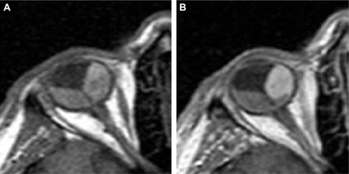 Figure 8 Arterial enhancement of choroidal melanoma on MRI scan enabling imaging differentiation between the tumor and retinal detachment.