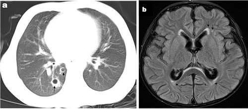 Figure 3 (a) Chest CT showed pulmonary inflammation relieved, but cavitary lesions formed (black arrows); (b) Brain MRI of the brain revealed ventriculomegaly, along with abnormal signal intensities observed in the bilateral precornu, the left frontal lobe, and the triangular region of white matter (black arrows).