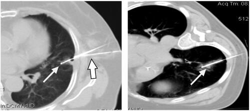 Figure 4. Radiofrequency electrode needles were implanted under CT monitoring (thin arrow) according to different positions of the lesions. A thousand leaf needle was placed near the pleura to continuously infusion 5% lidocaine to maintain anesthesia (thick arrow). After ablation, a halo sign was observed around the lesions.