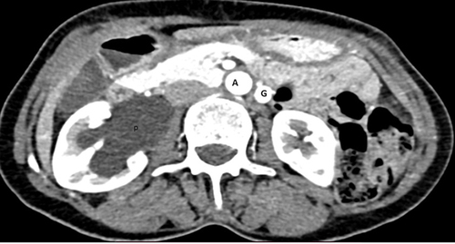 Figure 2 Cross-sectional image shows dilated left gonadal vein (g) going along side the aorta (a) and dilated right renal pelvis (p).