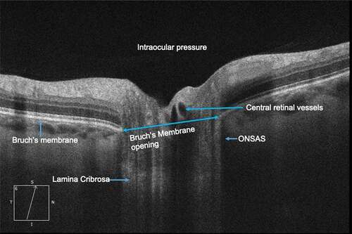 Figure 1. Anatomy of the optic nerve head as seen on optical coherence tomography imaging. ONSAS- Optic nerve subarachnoid space